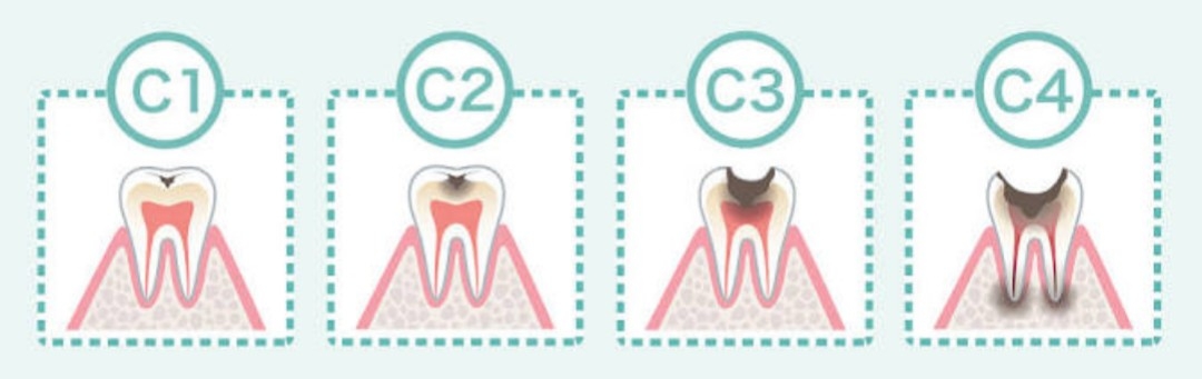 虫歯の進行図