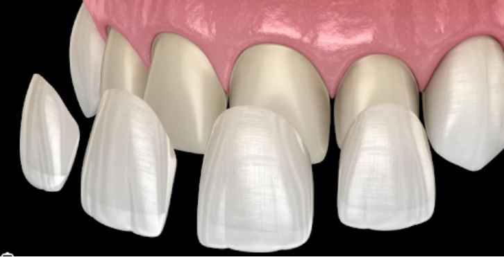 ラミネートべニア