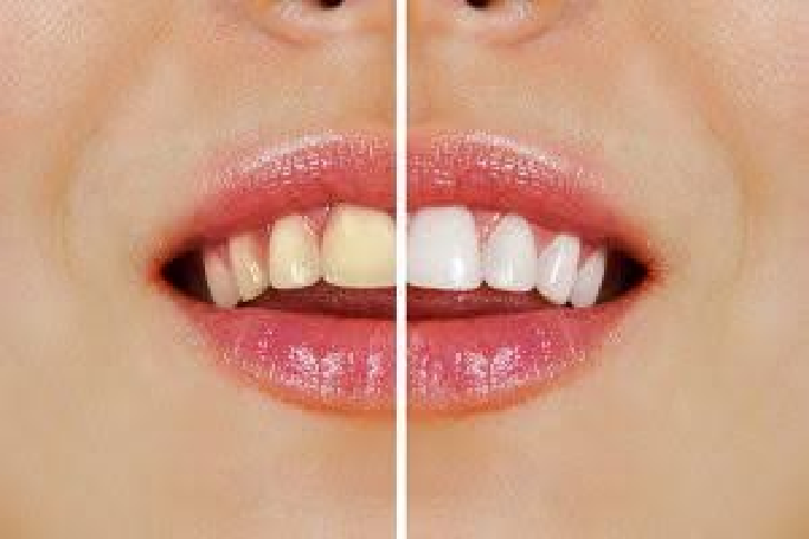 ホワイトニングについて