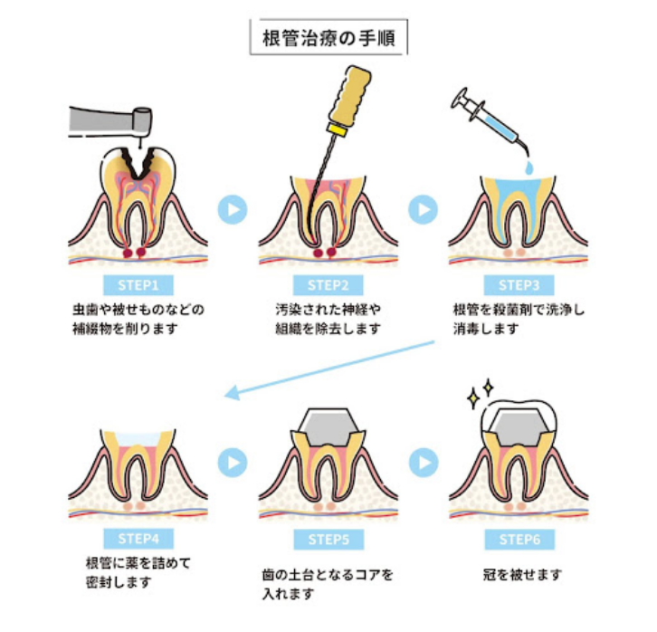 根管治療とは？必要性と目的